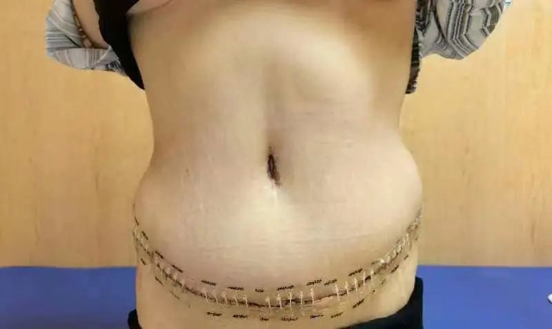 腹壁成形术——大肚腩也可以成为“小腰精”！